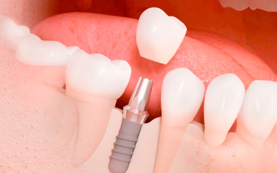 implantes dentales