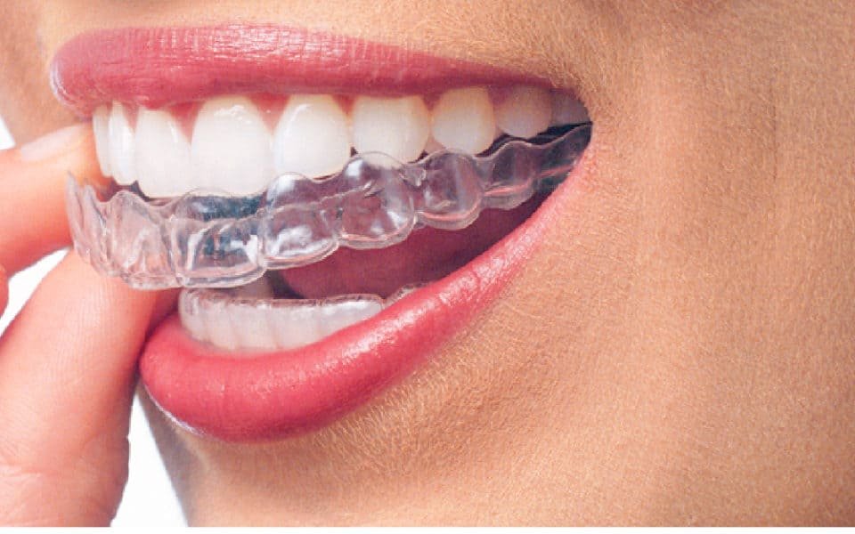 Invisalign santander