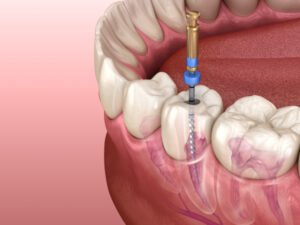 endodoncia en santander