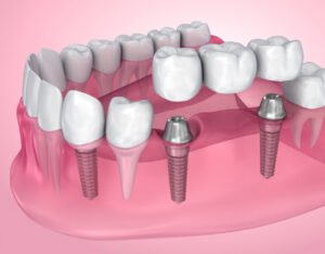 Implantes dentales de carga inmediata en Santander